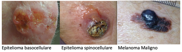 Tumori cutanei: basocellulare, spinocellulare, melanoma